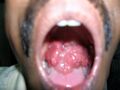 Rhinosporidiosis