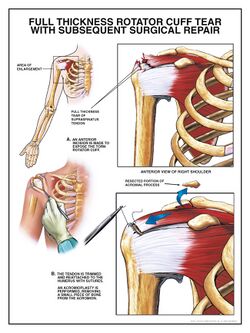 Rotator cuff tear surgical repair procedure