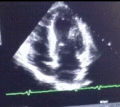 4 chamber view of the heart