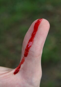 Bleeding wound on thumb