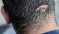 Dissecting cellulitis of the scalp in a 40-year-old male of African descent