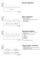 Cheyne–Stokes respiration