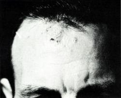 Coccidioidomycosis granulomas on forehead
