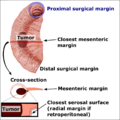Edges and margins in intestinal tumor