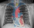Mediastinal structures on chest X-ray, annotated