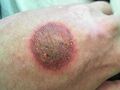 Aerosol-induced frostbite on the skin.