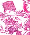 Pulmonary talcosis low magnification