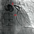 Coronary stenosis