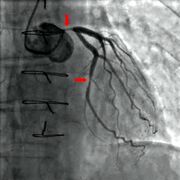 What is the main cause of atherosclerosis? What is the best treatment for atherosclerosis? Can Atherosclerosis be cured? Can you live a long life with atherosclerosis? Can Apple cider vinegar clean out your arteries? What are the warning signs of clogged arteries? What are the stages of atherosclerosis? Can you reverse atherosclerosis naturally? Does aspirin help atherosclerosis? What dissolves artery plaque? What is difference between atherosclerosis and arteriosclerosis? How fast does atherosclerosis progress?