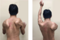 Facioscapulohumeral muscular dystrophy
