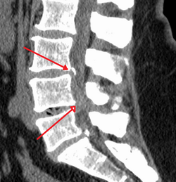 Spinal Canal Stenosis - Moderate to severe spinal stenosis a the levels of L3/4 and L4/5
