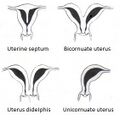 Uterine malformation