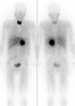 Pheochromocytoma scan