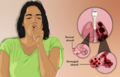 Emphysema