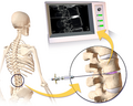 Lumbar provocative discography