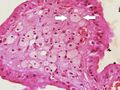 Histopathology of cholesterolosis, with annotated foam cell