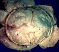 Superior sagittal sinus