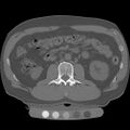 Trabecular bone of the spine by quantitative computed tomography