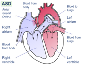 Atrial septal defect
