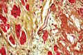 Cardiac amyloidosis under very high magnification with Movat's stain
