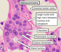 Invasive carcinoma of no special type