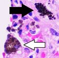 Histopathology of anthracotic macrophage in lung, annotated