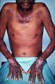 Symptoms of Pellagra