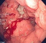 Linitis plastica seen on endoscopy