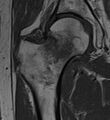 T1 TSE MRI of hip fracture
