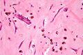 Myxoid tumor