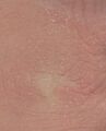 Xeroderma on knuckles