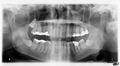 Panoramic View of Teeth
