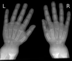 X-ray of Hands Identifying Rickets