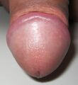 Glans penis of a human