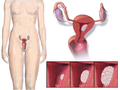 Endometrial cancer