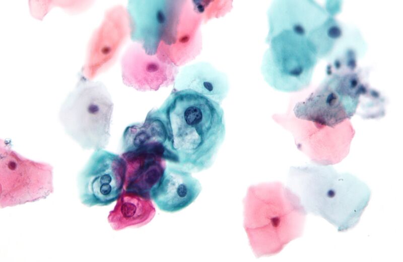 File:Low-grade squamous intraepithelial lesion.jpg