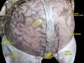 Superior sagittal sinus