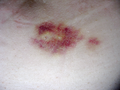 Medical Implant
