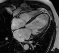 Cardiac magnetic resonance imaging