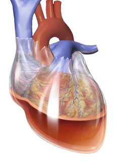CardiacTamponade