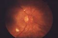Cotton wool spots in proliferative retinopathy