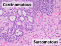 Mixed tumor