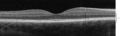 Spectral-domain OCT cross-section of the macula