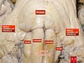 Medulla oblongata, pons and middle cerebellar peduncle