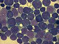 bone marrow smear (large magnification) from a person with acute lymphoblastic leukemia