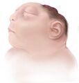 An illustration showing anencephaly
