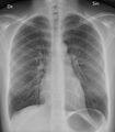 Normal posteroanterior (PA) chest radiograph (X-ray)