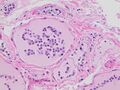 Histopathology of thyroid parenchyma with autolytic changes