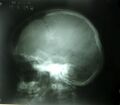 Cleidocranial2