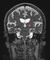 MRI-guided HIFU for essential tremor